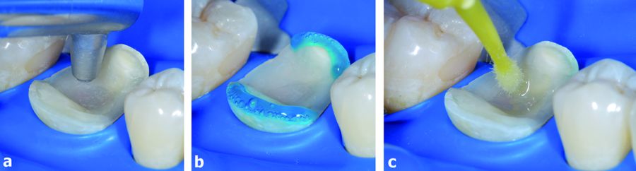 The adhesive treatment of the cavity