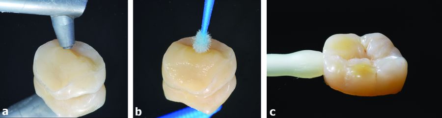 7. Tratamiento adhesivo de la pieza. a) Se pule con arena la superficie inferior de la pieza. b) Aplicación de un silano y distribución de resina adhesiva en el interior de la cavidad pretratada (Tabla 2). c) La endocorona está lista para ser cementada.