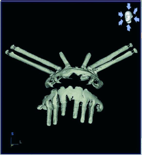  Utilización de 4 cigomáticos y 2 implantes angulados premaxilares.