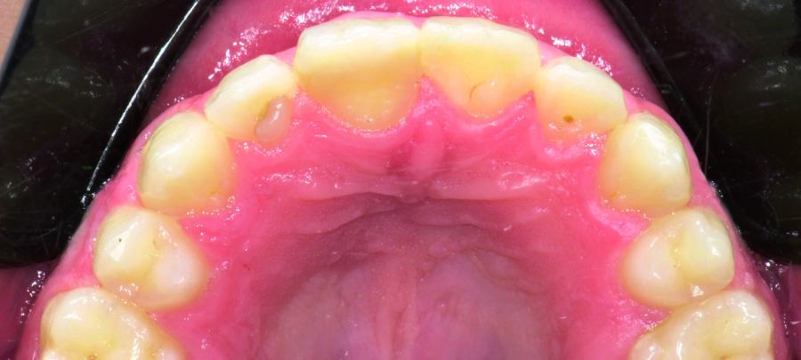 10. Vista oclusal del autotransplante a los 10 años. El paciente tiene ahora 20 años.