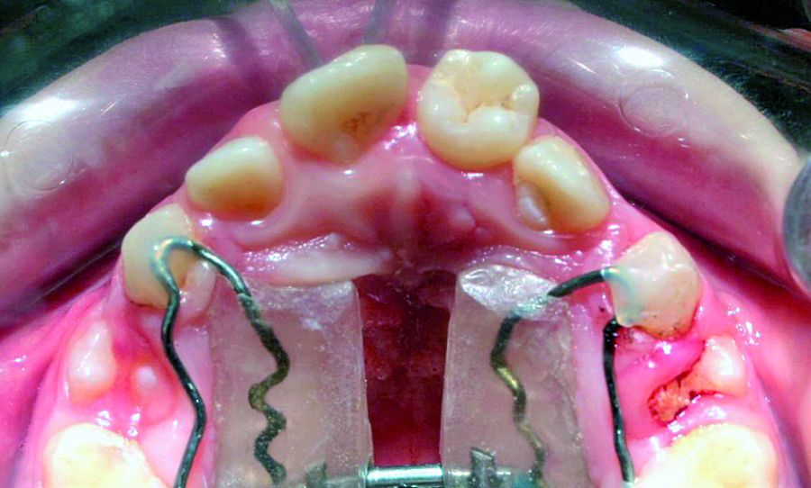Occlusal view of autransplanted tooth one month after the surgical procedure